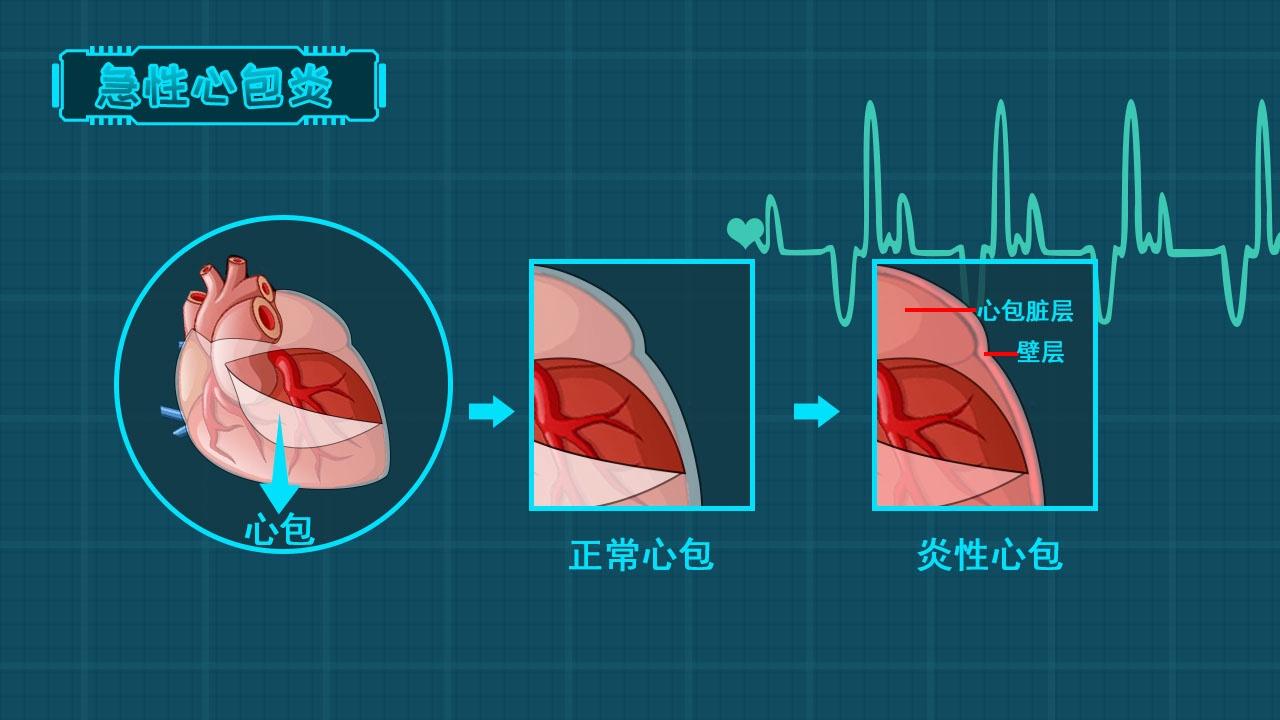 什么是急性心包炎?